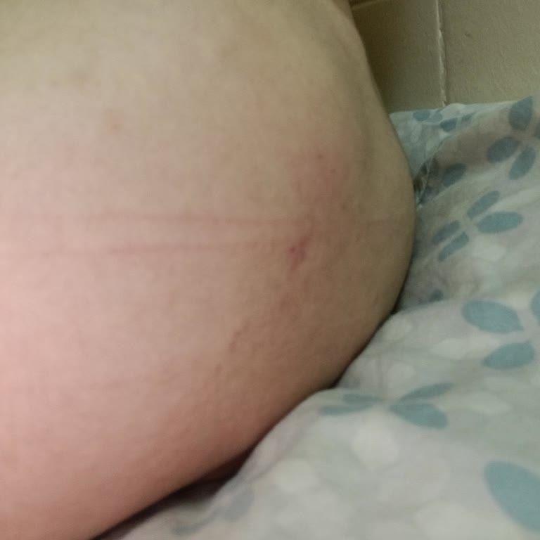 Palmolive Purple Shower Gel Caused Full-Body Redness and Persistent Itching