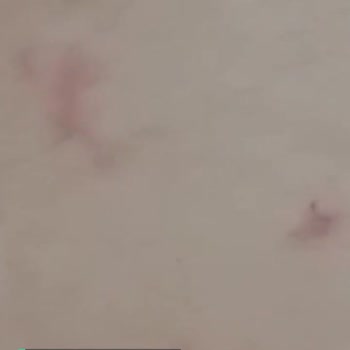 Veet Cildimi Tahriş Etti