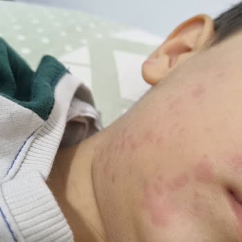 Sorvagen Smart Kids Balık Yağı Şurubu Sonrası Ciddi Alerjik Reaksiyon