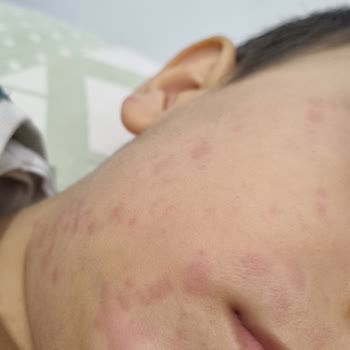 Sorvagen Smart Kids Balık Yağı Şurubu Sonrası Ciddi Alerjik Reaksiyon