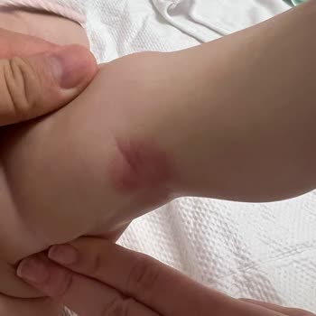 Mustela Ürünleri Bebeğimin Cildini Daha Kötü Hale Getirdi