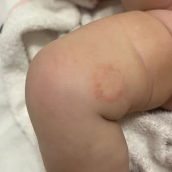 Mustela Ürünleri Bebeğimin Cildini Daha Kötü Hale Getirdi