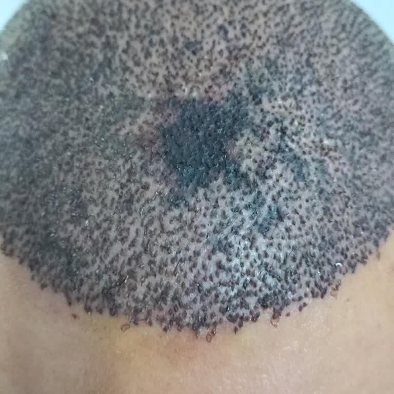 Murat Makasçı Klinik Saç Ekimi Sonrası Kalıcı Hasar Ve Mağduriyet!