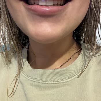 Dolgu Sonrası Ördek Dudak Ve Geçmeyen Topaklanma Mağduriyeti