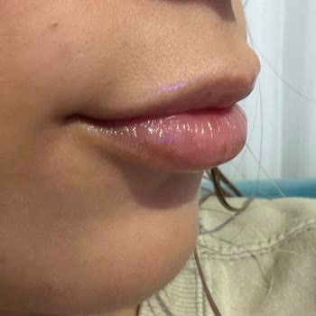 Dolgu Sonrası Ördek Dudak Ve Geçmeyen Topaklanma Mağduriyeti