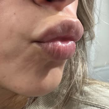 Dolgu Sonrası Ördek Dudak Ve Geçmeyen Topaklanma Mağduriyeti