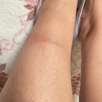 Sağlığa Zararlı Ve Ayıplı Ürün Nedeniyle İade Talebi