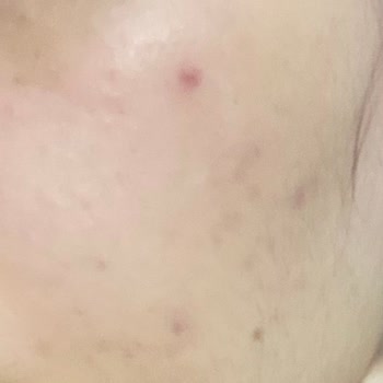 Yves Rocher Ürünleri Cildimde İltihaplı Sivilce Ve İzlere Sebep Oldu