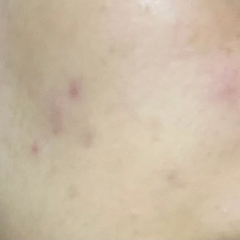 Yves Rocher Ürünleri Cildimde İltihaplı Sivilce Ve İzlere Sebep Oldu