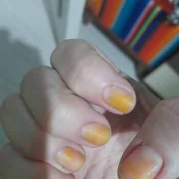 Pastel Oje Tırnaklarımı Sararttı Sağlığım Tehlikede