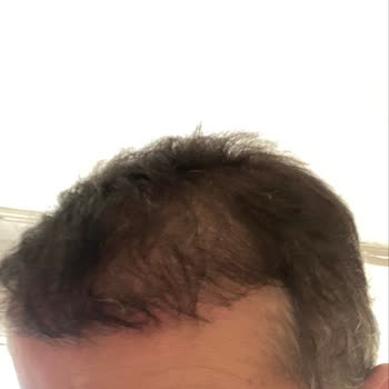 Saç Ekimi Sonrası Hayal Kırıklığı Ve Şeffaflık Eksikliği