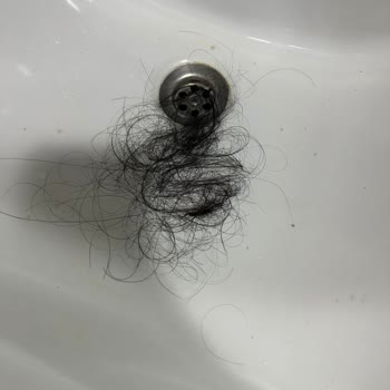 Saç Kaynak İşlemi Sonrası Dökülme Ve Kötü Müşteri Deneyimi