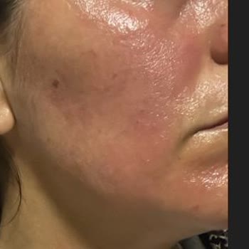 Yves Rocher Ürünleri Cildimde Ciddi Reaksiyona Sebep Oldu