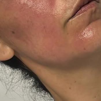 Yves Rocher Ürünleri Cildimde Ciddi Reaksiyona Sebep Oldu