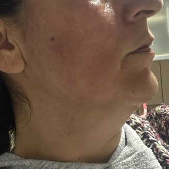 Yves Rocher Ürünleri Cildimde Ciddi Reaksiyona Sebep Oldu