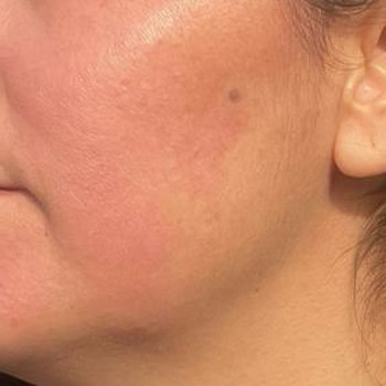 Yves Rocher Ürünleri Cildimde Ciddi Reaksiyona Sebep Oldu