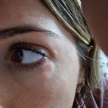 Göz Altı Kremi Ciddi Alerjik Reaksiyona Sebep Oldu