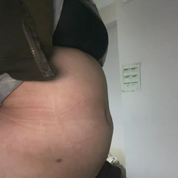 Ameliyat Sonrası Mağduriyet Ve Para İadesi Talebim