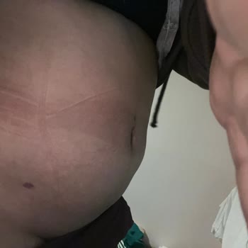 Ameliyat Sonrası Mağduriyet Ve Para İadesi Talebim