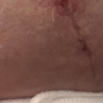 Ameliyat Sonrası Mağduriyet Ve Para İadesi Talebim