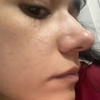 Estee Lauder Advanced Night Repair Serumu Cildimde Sivilce Ve Pütürlenme Yaptı