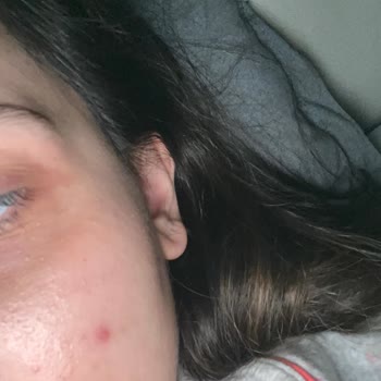 Cilt Sorunu Yaşadığım Ürünün İadesi Red Edildi, Mağduriyetim Giderilmiyor