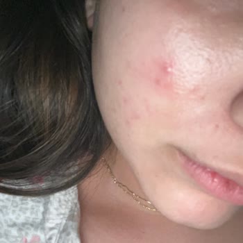 Cilt Sorunu Yaşadığım Ürünün İadesi Red Edildi, Mağduriyetim Giderilmiyor