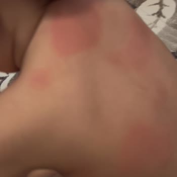 LCW'den Alınan Bebek Uyku Tulumu Ciltte Alerji Ve Kabarcık Yaptı