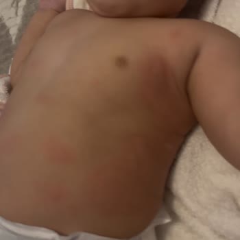 LCW'den Alınan Bebek Uyku Tulumu Ciltte Alerji Ve Kabarcık Yaptı