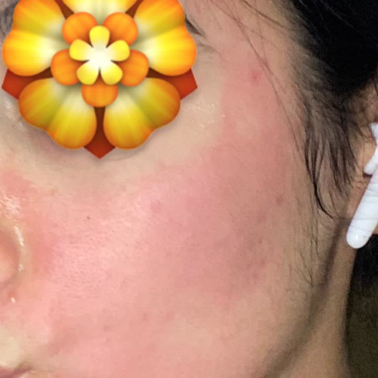 SHE Vec Red Of Love Kırmızı Serumda Ani Ve Şiddetli Cilt Reaksiyonu