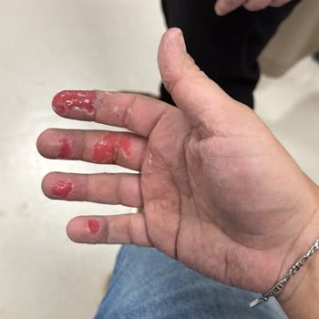 Sıfır Fiat Egea'da Motor Arızası Ve Yangın Sonrası Yaşanan Mağduriyet