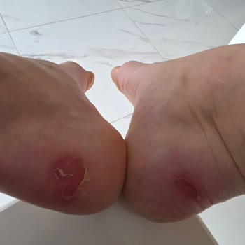 Kısa Sürede Ciddi Ayak Yaralarına Sebep Olan Ayakkabı İadesi Talebi