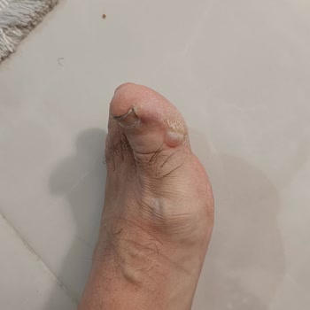 Aldığım Ayakkabı Ayağımı Yaraladı, Değişim Ve İade Reddedildi