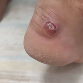 Aldığım Ayakkabı Ayağımı Yaraladı, Değişim Ve İade Reddedildi