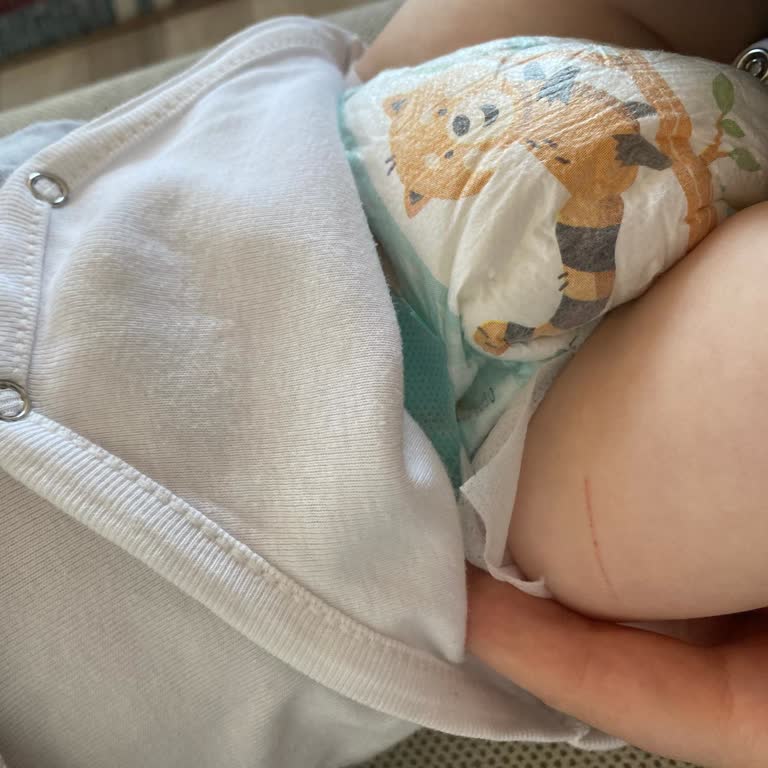 Prima 3 Numara Bebek Bezi Bebeğimin Cildinde Kesik Ve İz Oluşturdu