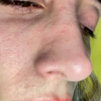 Hediye Edilen Krem Yüzümde Yoğun Sivilce Ve Cilt Sorunlarına Sebep Oldu