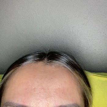 Hediye Edilen Krem Yüzümde Yoğun Sivilce Ve Cilt Sorunlarına Sebep Oldu