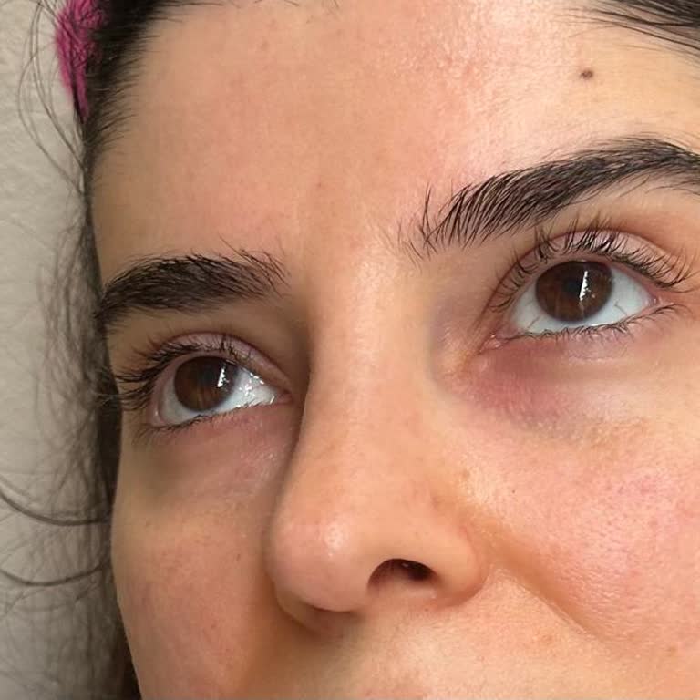 Caudalie Ürünü Gözümde Şişlik Ve Alerji Yaptı, Firma Dönüş Yapmıyor