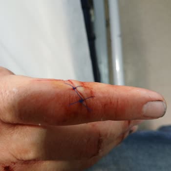 Sharkninja Türkiye Cam Sürahi Patladı, Yaralandım; Shark Ninja İlgisiz Kaldı