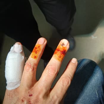 Sharkninja Türkiye Cam Sürahi Patladı, Yaralandım; Shark Ninja İlgisiz Kaldı