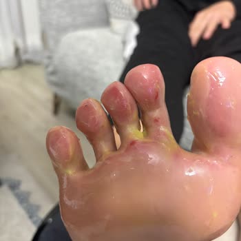 Aldığım Ayakkabı Ayağımda Yaralara Sebep Oldu, Mağduriyetim Giderilmedi