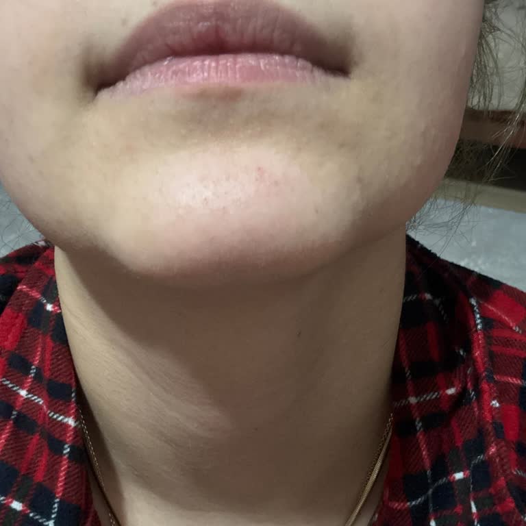 Neutrogena El Kremi Sonrası Ciltte Sivilce Ve Komedon Oluşumu