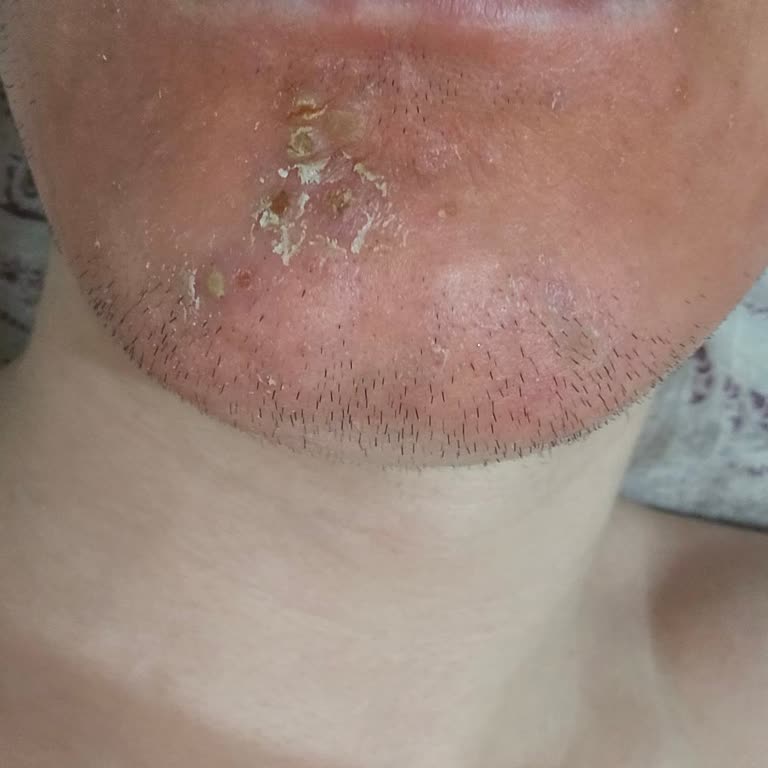 La Roche Posay Sivilce Ürünü Yüzümde Şiddetli Yanma Ve Kızarıklık Yaptı