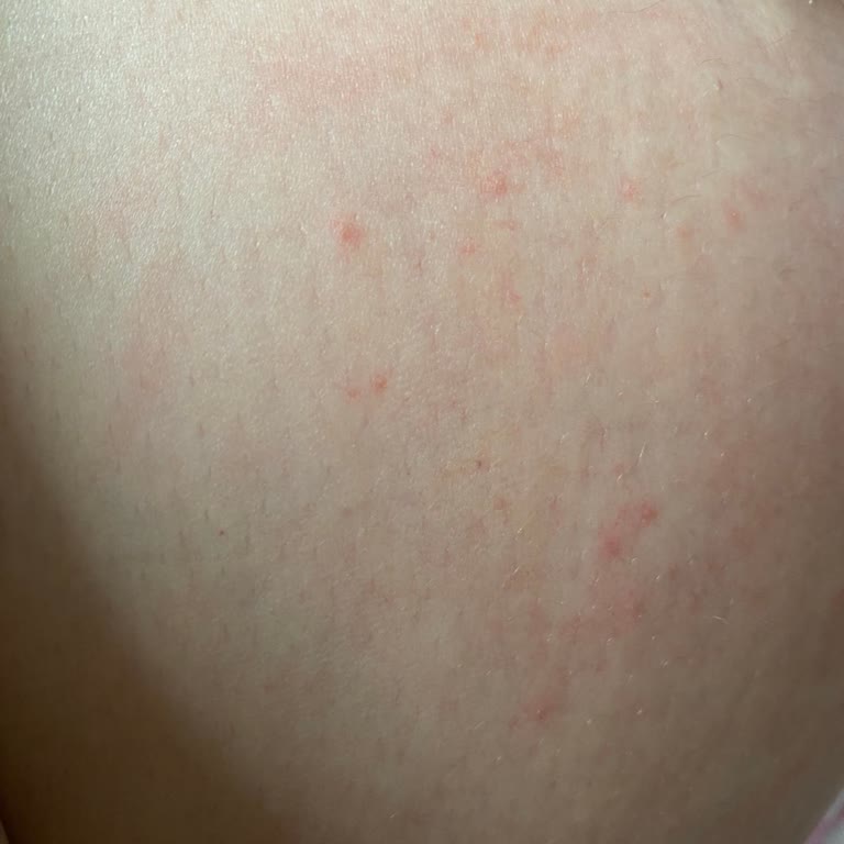 Bebek Yağı Ciddi Alerjiye Yol Açtı, Güvenlik Endişesi Yaşıyorum