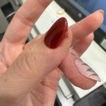 Hijyen Eksikliği Nedeniyle Tırnak İşleminden Sonra Ciddi Enfeksiyon Ve Mağduriyet Yaşadım