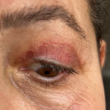 Göz Kapağı Ameliyatı Sonrası Yaşadığım Mağduriyet Ve Doktorun İlgisiz Yaklaşımı