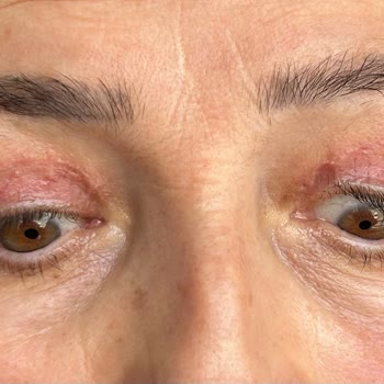 Göz Kapağı Ameliyatı Sonrası Yaşadığım Mağduriyet Ve Doktorun İlgisiz Yaklaşımı