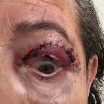 Göz Kapağı Ameliyatı Sonrası Yaşadığım Mağduriyet Ve Doktorun İlgisiz Yaklaşımı