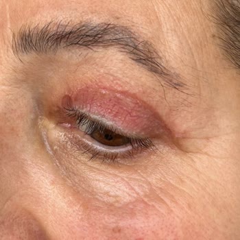 Göz Kapağı Ameliyatı Sonrası Yaşadığım Mağduriyet Ve Doktorun İlgisiz Yaklaşımı