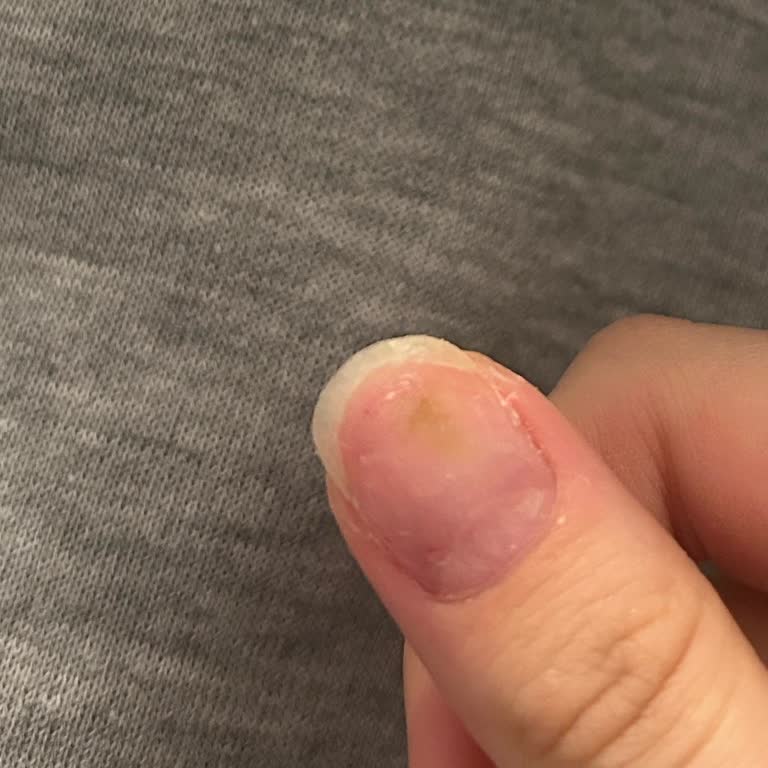 Nu&Ra Nail Beauty Center Protez Tırnak Sonrası Mantar Enfeksiyonu Ve Hijyen Sorunu!